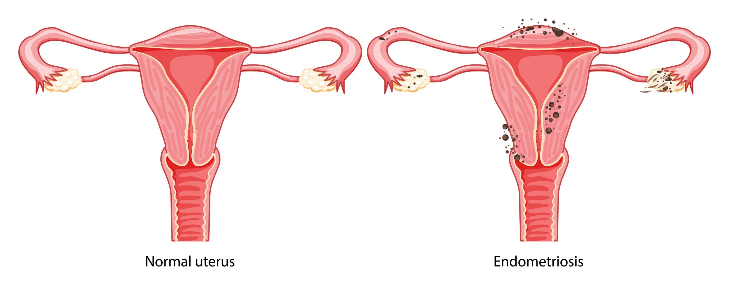 Endometriosis treatment in Ghansoli